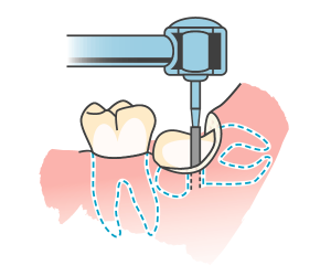 歯冠の分割